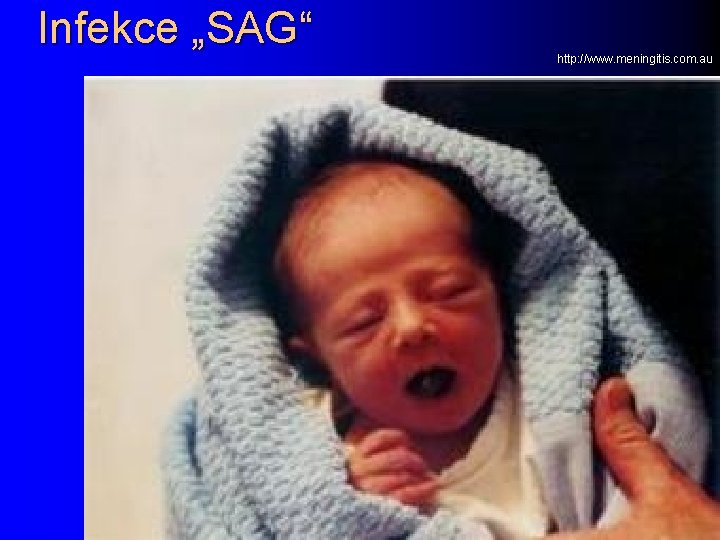 Infekce „SAG“ http: //www. meningitis. com. au 