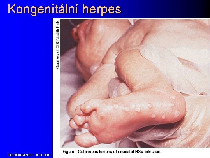 Kongenitální herpes http: //farm 4. static. flickr. com 