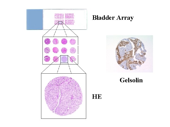 Bladder Array Gelsolin HE 