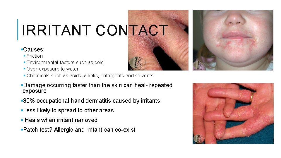 IRRITANT CONTACT §Causes: § Friction § Environmental factors such as cold § Over-exposure to