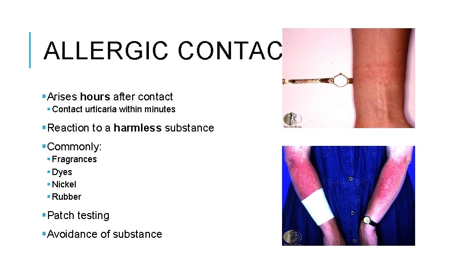 ALLERGIC CONTACT §Arises hours after contact § Contact urticaria within minutes §Reaction to a