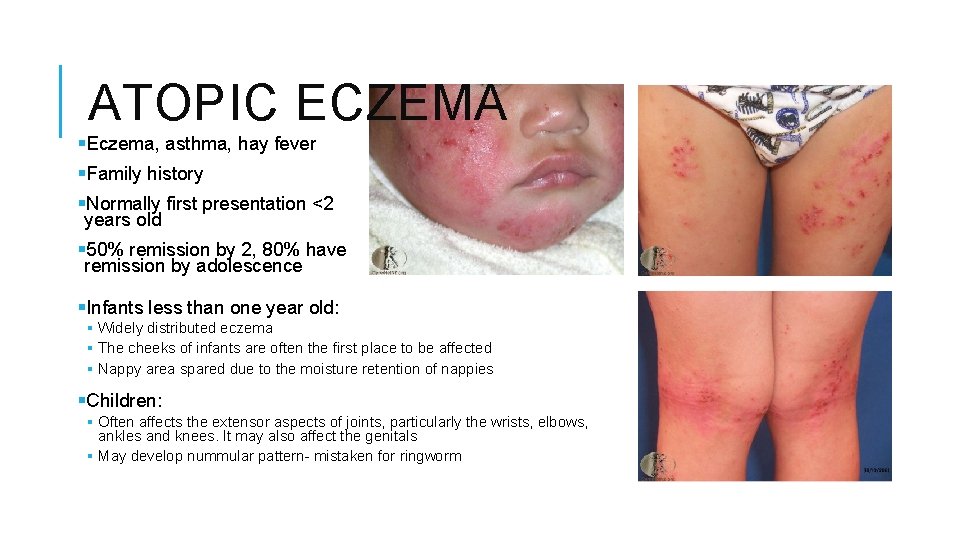 ATOPIC ECZEMA §Eczema, asthma, hay fever §Family history §Normally first presentation <2 years old