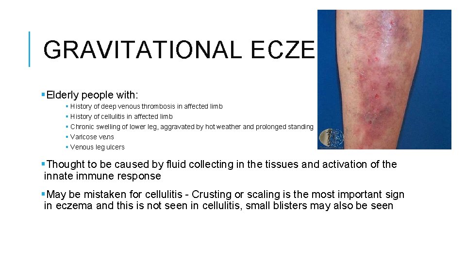 Gravitational Eczema Icd 10 at Joe Adkins blog