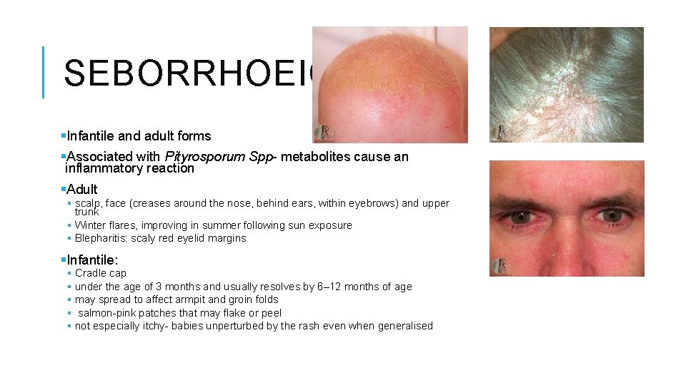 SEBORRHOEIC §Infantile and adult forms §Associated with Pityrosporum Spp- metabolites cause an inflammatory reaction