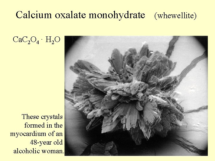 Calcium oxalate monohydrate Ca. C 2 O 4 · H 2 O These crystals