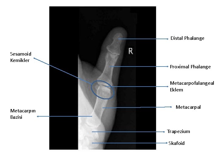 Distal Phalange Sesamoid Kemikler Proximal Phalange Metacarpofalangeal Eklem Metacarpın Bazisi Metacarpal Trapezium Skafoid 