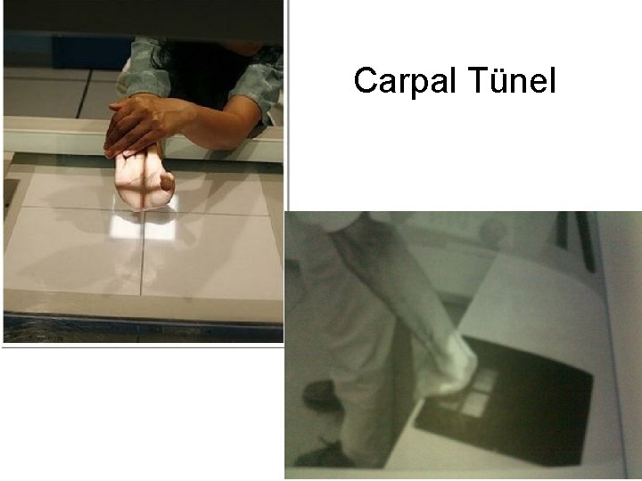 Carpal Tünel 