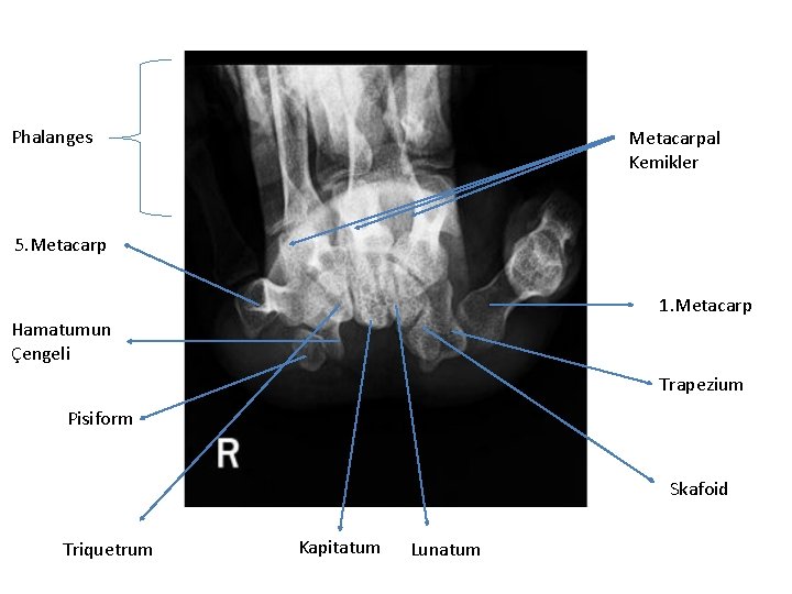 Phalanges Metacarpal Kemikler 5. Metacarp 1. Metacarp Hamatumun Çengeli Trapezium Pisiform Skafoid Triquetrum Kapitatum