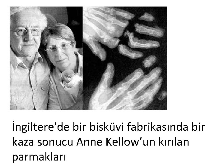 İngiltere’de bir bisküvi fabrikasında bir kaza sonucu Anne Kellow’un kırılan parmakları 