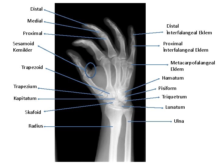 Distal Medial Proximal Sesamoid Kemikler Trapezoid Distal İnterfalangeal Eklem Proximal İnterfalangeal Eklem Metacarpofalangeal Eklem