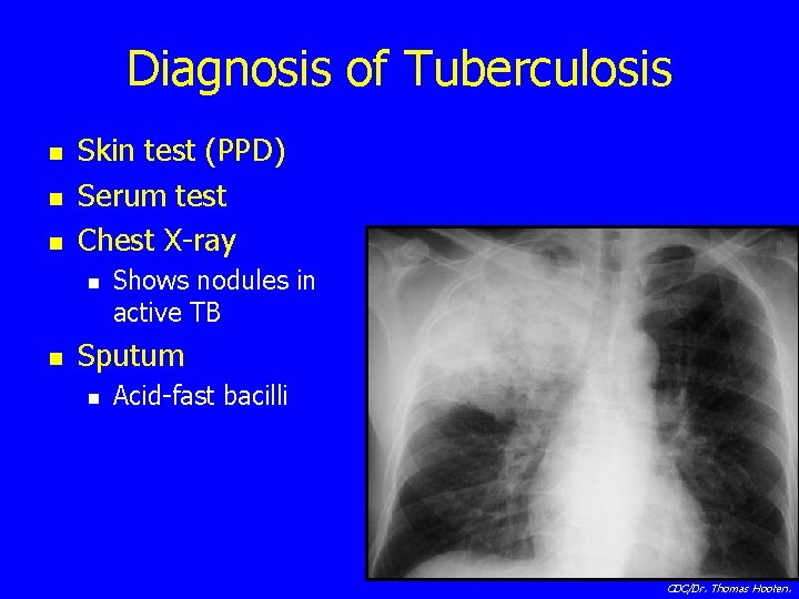 Diagnosis of Tuberculosis n n n Skin test (PPD) Serum test Chest X-ray n