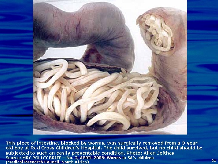 This piece of intestine, blocked by worms, was surgically removed from a 3 -yearold