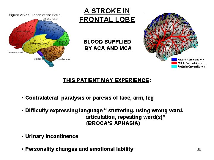 A STROKE IN FRONTAL LOBE BLOOD SUPPLIED BY ACA AND MCA THIS PATIENT MAY
