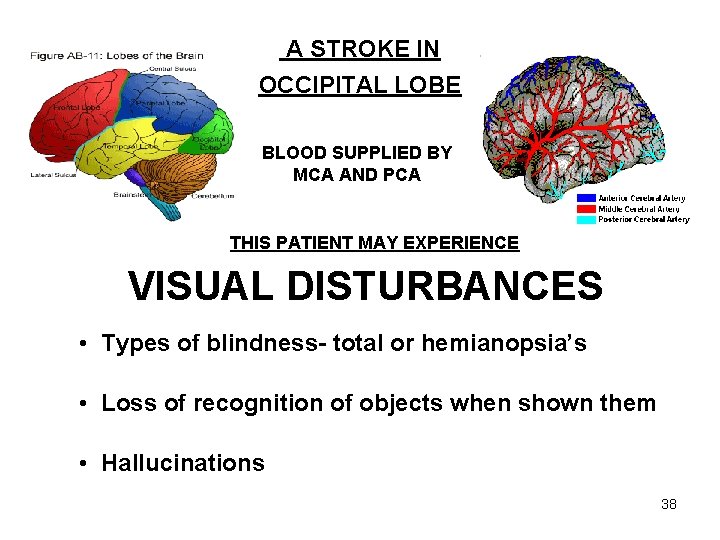 A STROKE IN OCCIPITAL LOBE BLOOD SUPPLIED BY MCA AND PCA THIS PATIENT MAY