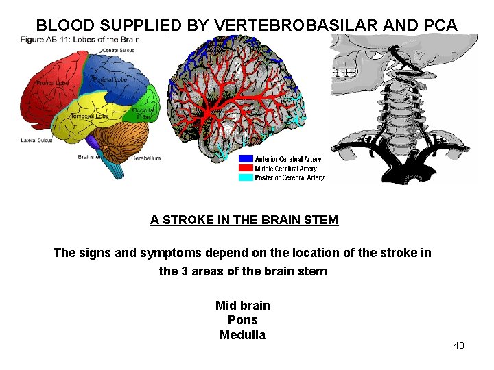 BLOOD SUPPLIED BY VERTEBROBASILAR AND PCA A STROKE IN THE BRAIN STEM The signs