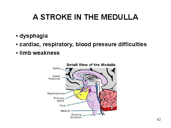 A STROKE IN THE MEDULLA • dysphagia • cardiac, respiratory, blood pressure difficulties •