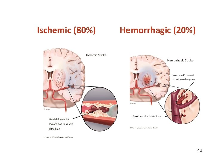 Ischemic (80%) Hemorrhagic (20%) 48 