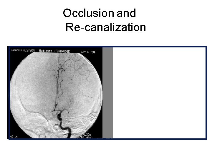 Occlusion and Re-canalization 
