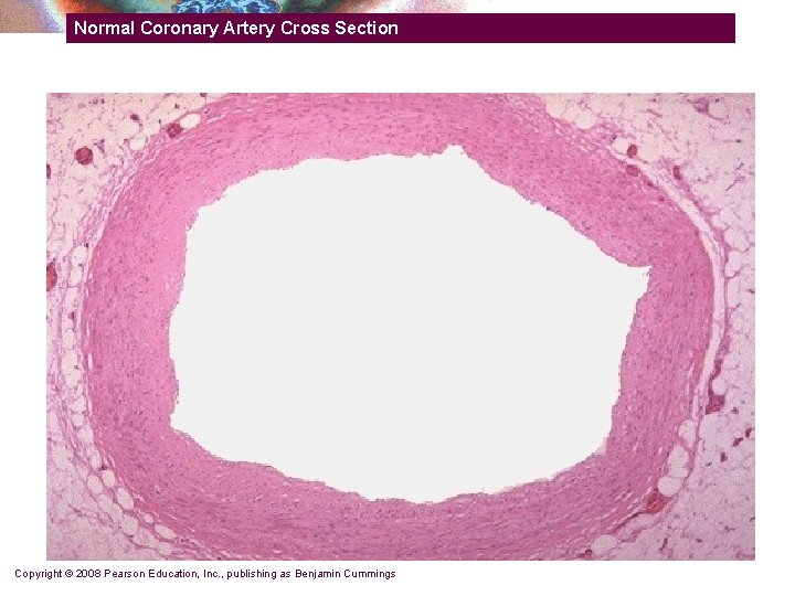 Normal Coronary Artery Cross Section Copyright © 2008 Pearson Education, Inc. , publishing as