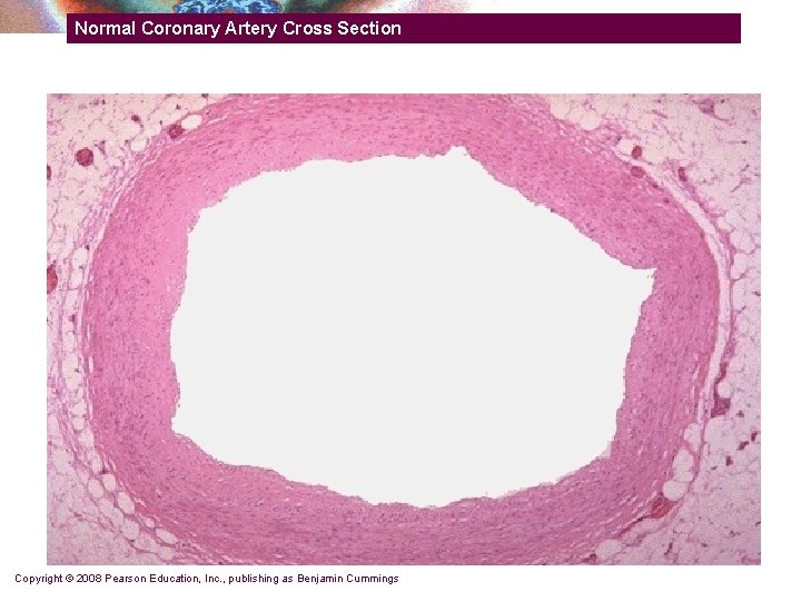 Normal Coronary Artery Cross Section Copyright © 2008 Pearson Education, Inc. , publishing as Normal Coronary Artery Cross Section Copyright © 2008 Pearson Education, Inc. , publishing as