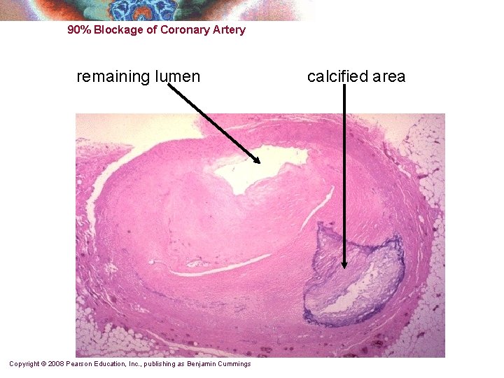 90% Blockage of Coronary Artery remaining lumen Copyright © 2008 Pearson Education, Inc. ,