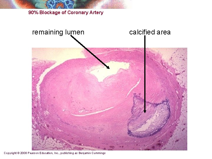 90% Blockage of Coronary Artery remaining lumen Copyright © 2008 Pearson Education, Inc. , 90% Blockage of Coronary Artery remaining lumen Copyright © 2008 Pearson Education, Inc. ,