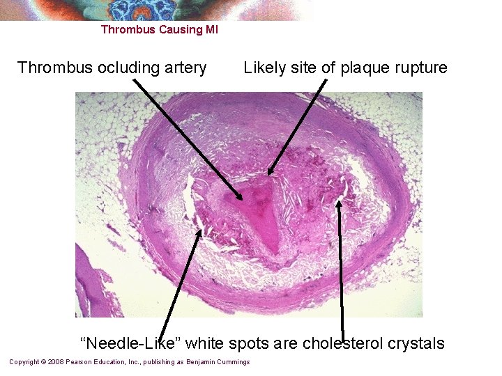 Thrombus Causing MI Thrombus ocluding artery Likely site of plaque rupture “Needle-Like” white spots