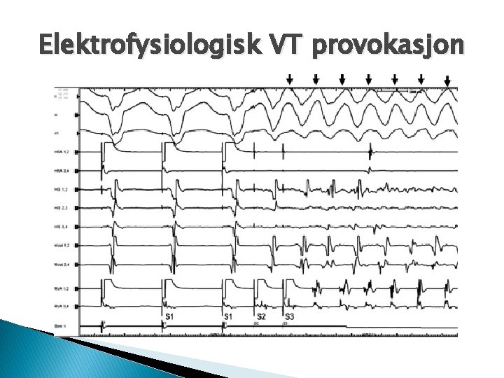 Elektrofysiologisk VT provokasjon 