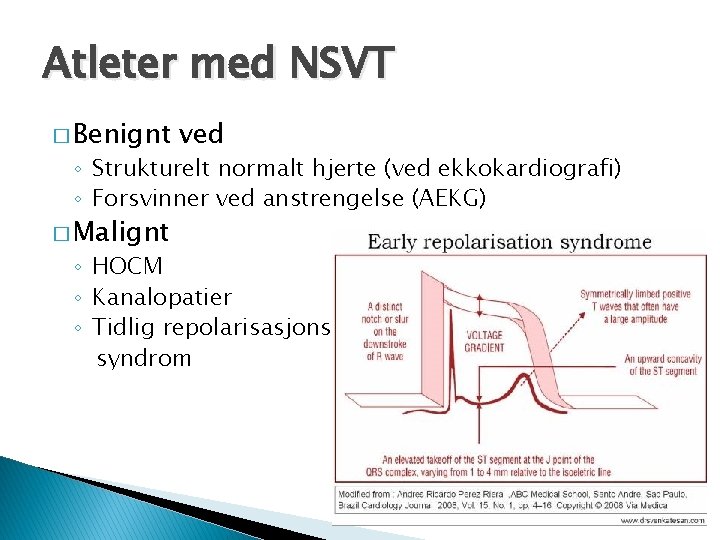 Atleter med NSVT � Benignt ved ◦ Strukturelt normalt hjerte (ved ekkokardiografi) ◦ Forsvinner