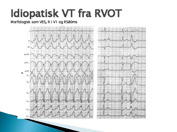 Idiopatisk VT fra RVOT Morfologisk som VES, R i V 1 og RS 80