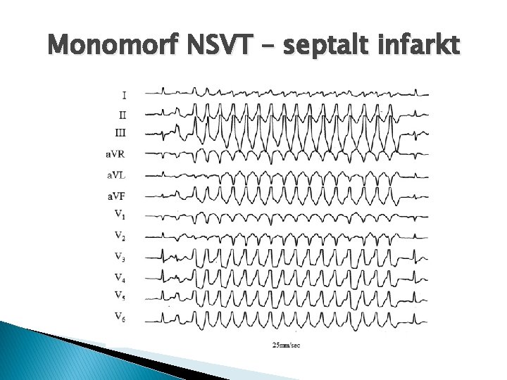 Monomorf NSVT – septalt infarkt 