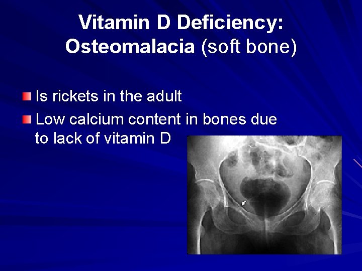 Vitamin D Deficiency: Osteomalacia (soft bone) Is rickets in the adult Low calcium content