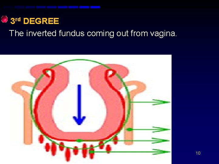  • 3 rd DEGREE The inverted fundus coming out from vagina. 10 