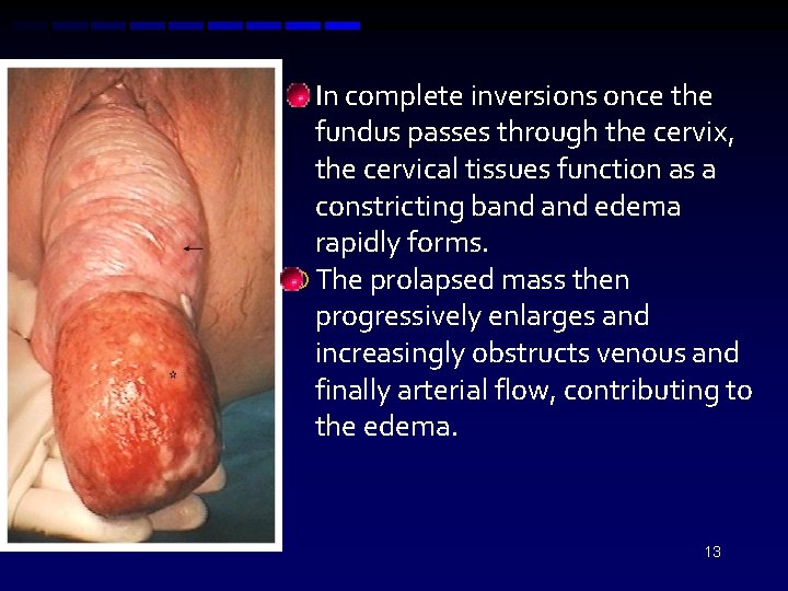  In complete inversions once the fundus passes through the cervix, the cervical tissues