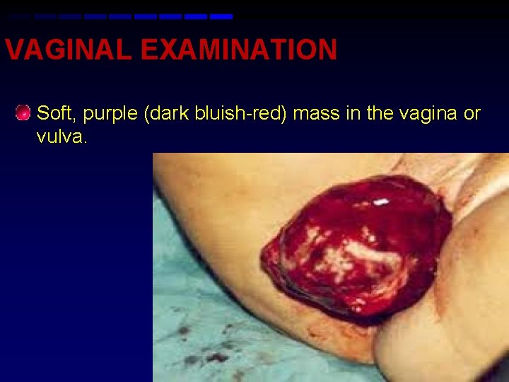 VAGINAL EXAMINATION • Soft, purple (dark bluish-red) mass in the vagina or vulva. 25