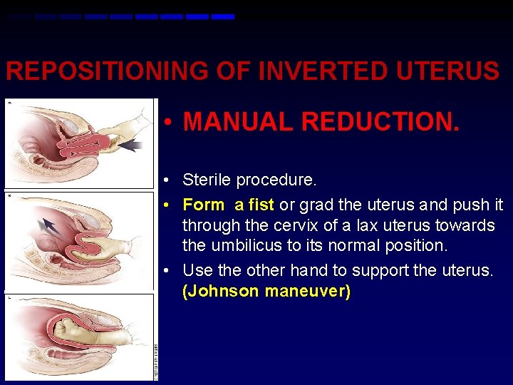 REPOSITIONING OF INVERTED UTERUS • MANUAL REDUCTION. • Sterile procedure. • Form a fist