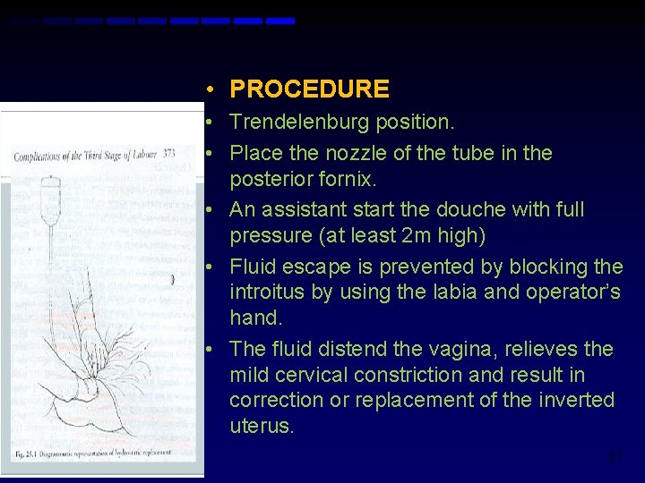  • PROCEDURE • Trendelenburg position. • Place the nozzle of the tube in