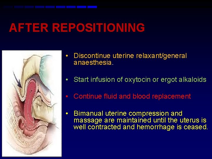 AFTER REPOSITIONING • Discontinue uterine relaxant/general anaesthesia. • Start infusion of oxytocin or ergot