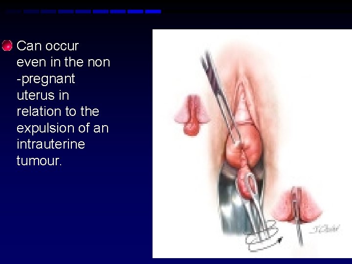  • Can occur even in the non -pregnant uterus in relation to the