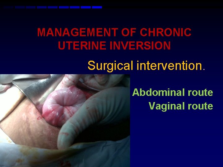MANAGEMENT OF CHRONIC UTERINE INVERSION Surgical intervention. Abdominal route Vaginal route 
