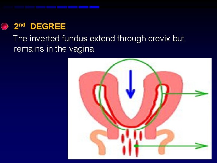  • 2 nd DEGREE The inverted fundus extend through crevix but remains in
