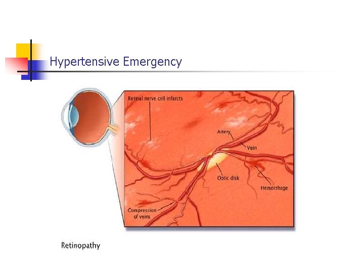 Hypertensive Emergency 