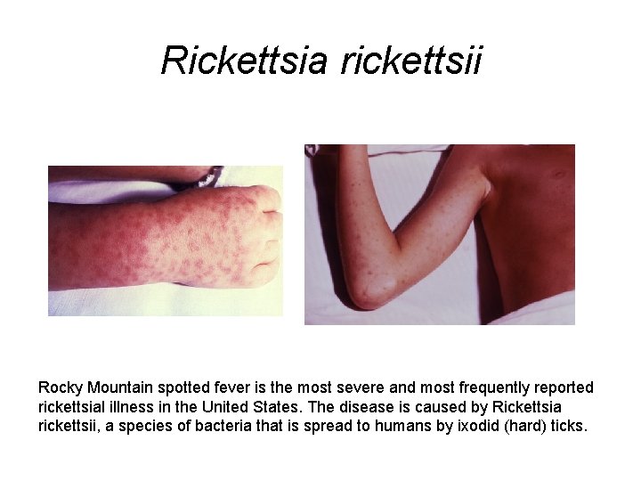 Rickettsia rickettsii Rocky Mountain spotted fever is the most severe and most frequently reported