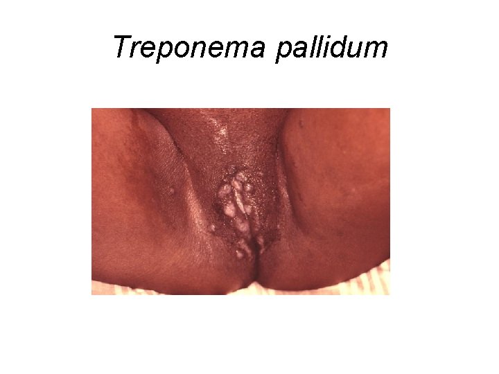 Treponema pallidum 