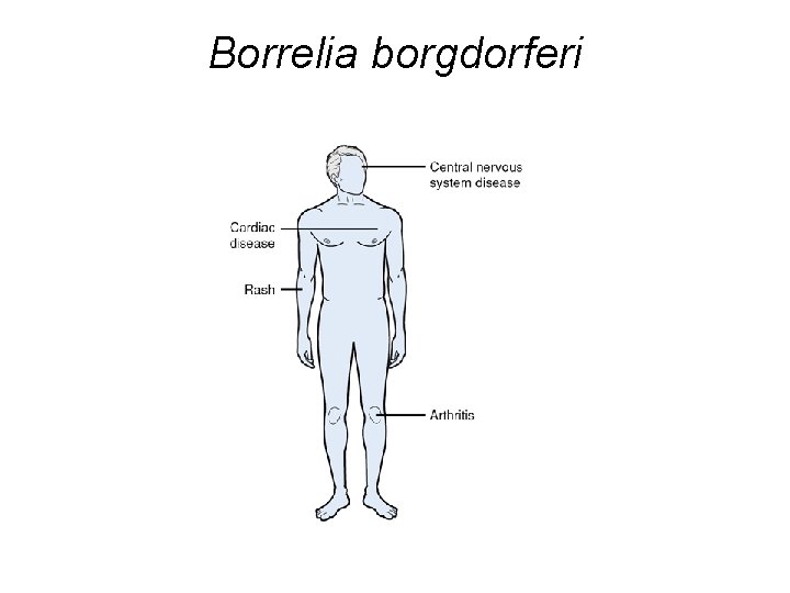 Borrelia borgdorferi 