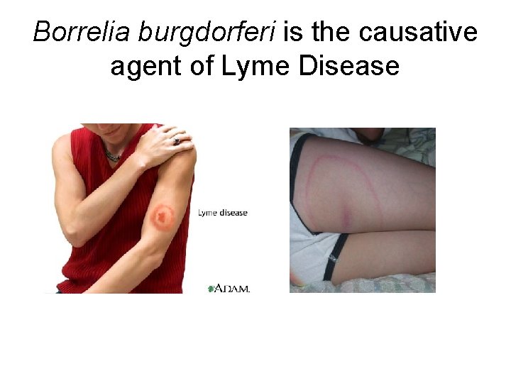 Borrelia burgdorferi is the causative agent of Lyme Disease 