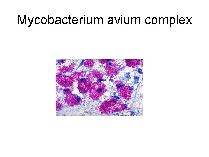 Mycobacterium avium complex 