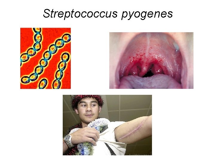 Streptococcus pyogenes 