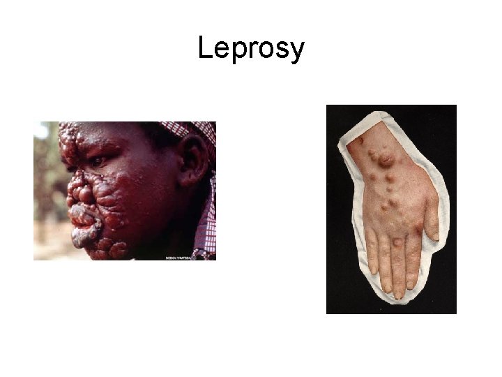 Leprosy 