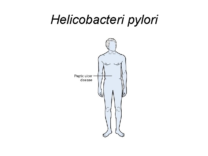 Helicobacteri pylori 